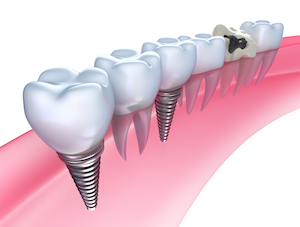 best dental implant dentist in tampa